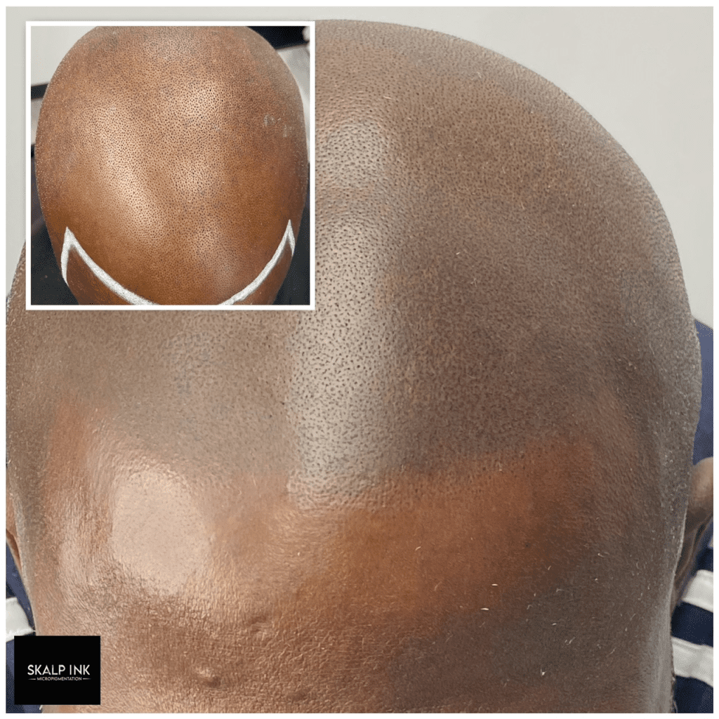 a man showing his scalp after an SMP treatment.