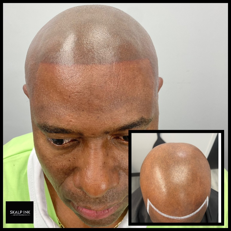 a man getting a scalp micropigmentation treatment.