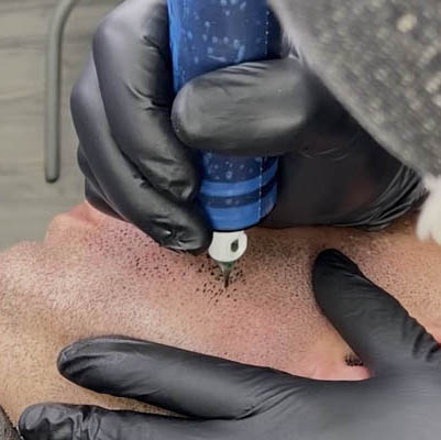 SMP procedure for facial hair by Skalp Ink Micropigmentation in Maryland