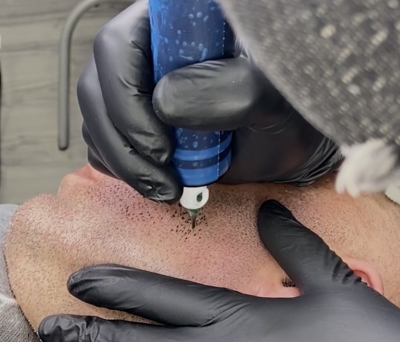 Skin Micropigmentation (SMP) procedure for facial hair