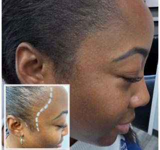 SMP treatment for women - before and after