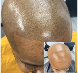 Skin Micropigmentation treatment for a man in Maryland - before and after results